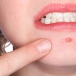 wpid blog acne - Ta chick