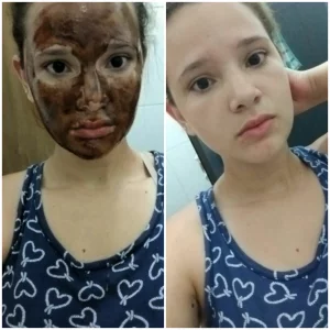 Máscara Caseira para Combater Cravos e Espinhas 28 img1459194635779.png