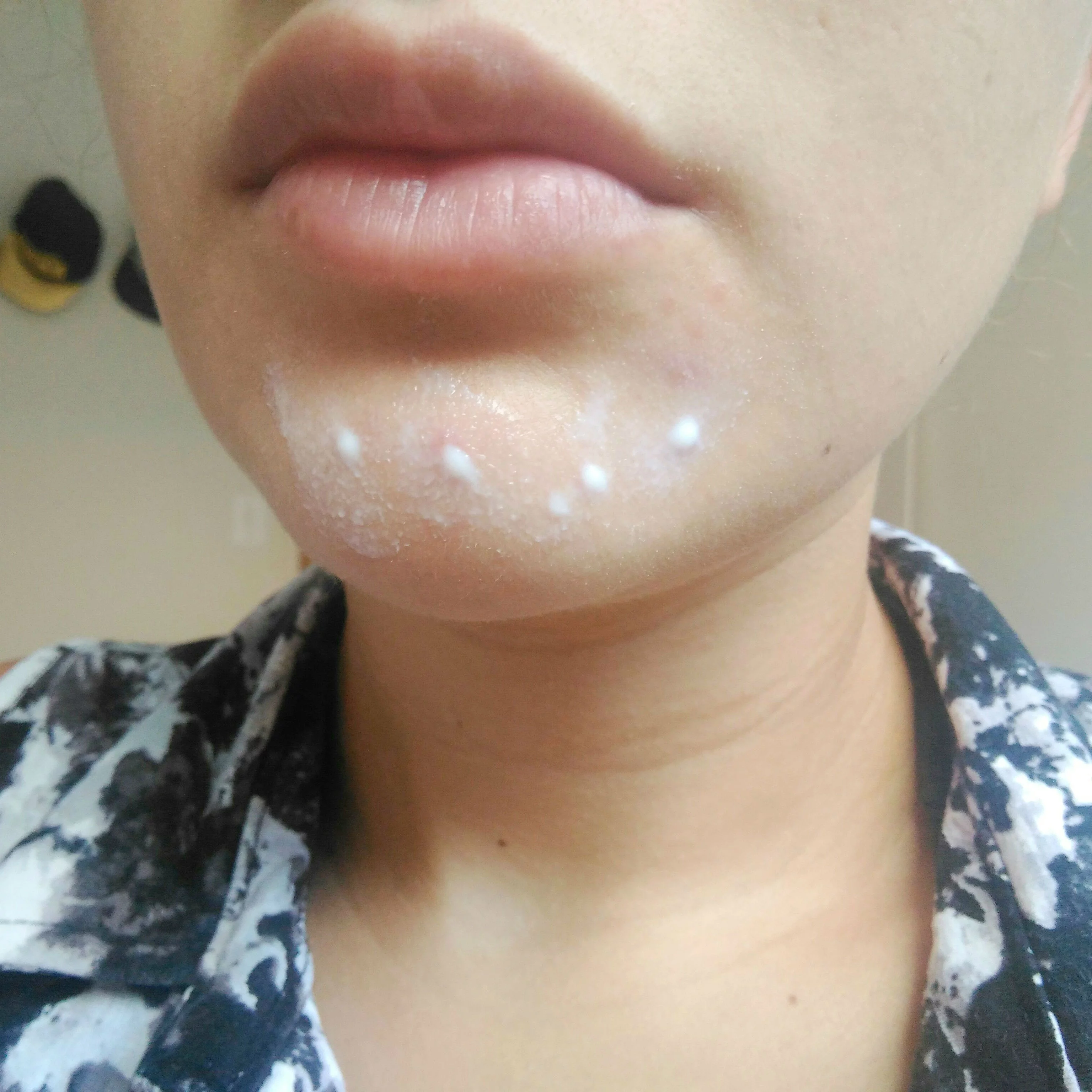 Leite de magnésia para acne Leite de magnésia para acne