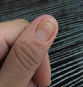 unhas com alergia unhas com alergia