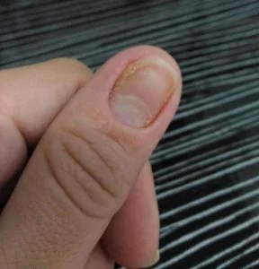 unhas com alergia unhas com alergia