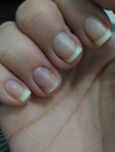 Unhas afetadas pela dermatite Unhas afetadas pela dermatite