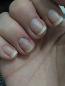 Unhas afetadas pela dermatite Unhas afetadas pela dermatite