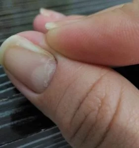 Alergia nas unhas descamando Alergia nas unhas descamando