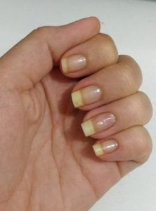 Alergia nas unhas, outras unhas Alergia nas unhas, outras unhas