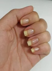Alergia nas unhas, outras unhas Alergia nas unhas, outras unhas