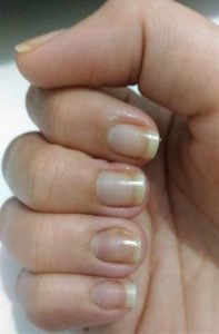 Alergia nas unhas ao esmalte Alergia nas unhas ao esmalte